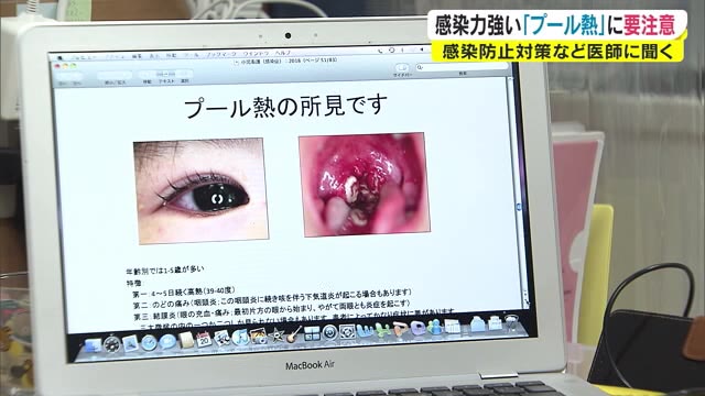 「プール熱」に注意！　子供は特に…　症状は？家庭内での対策は？専門家に聞く【岡山・香川】
